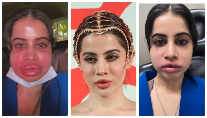 لِپ فلرز سرجری، عرفی جاوید کی نئی چونکا دینے والی ویڈیو سامنے آگئی