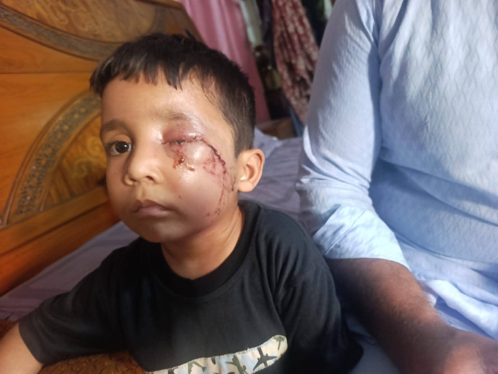 گجرات :کھاریاں میں کتے کے کاٹنے سے زخمی ہونے والا بچہ چل بسا
